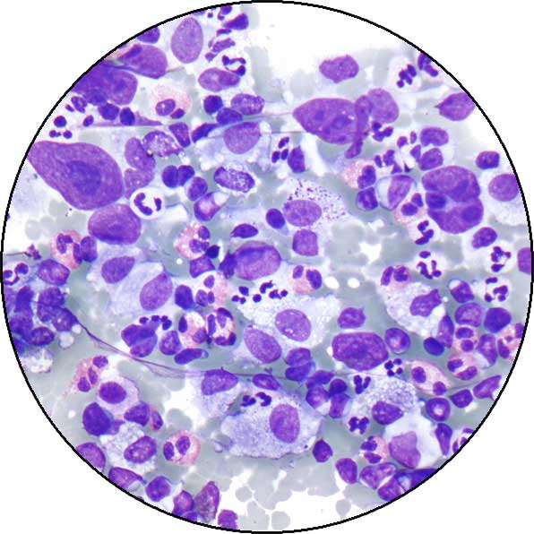 Hodgkin Lymphoma