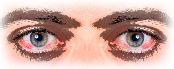 bloodshot eyes
