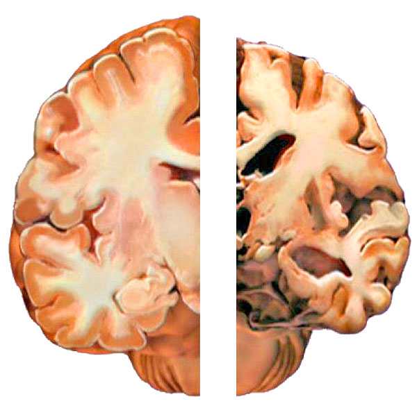 brain normal dementia