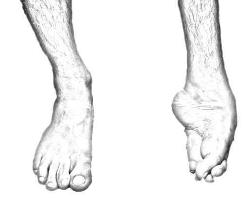 Talipes Equinovarus (clubfoot)