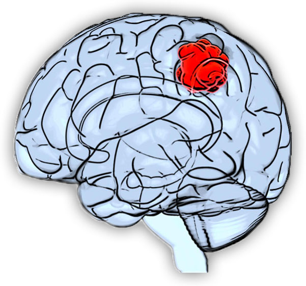 brain tumor