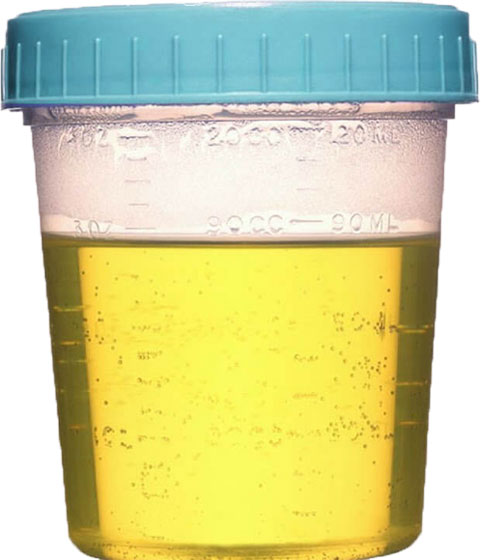 urinalysis