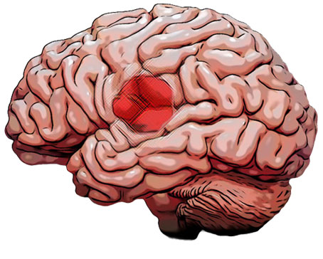 brain tumor