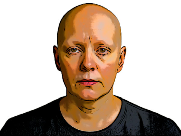 lovely alopecia totalis