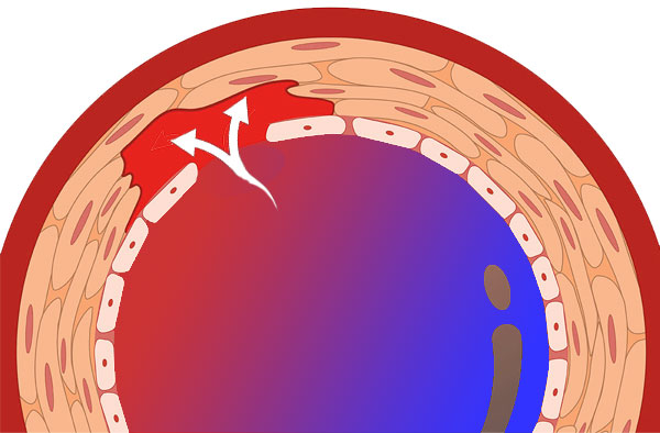 dissecting aortic aneuysm
